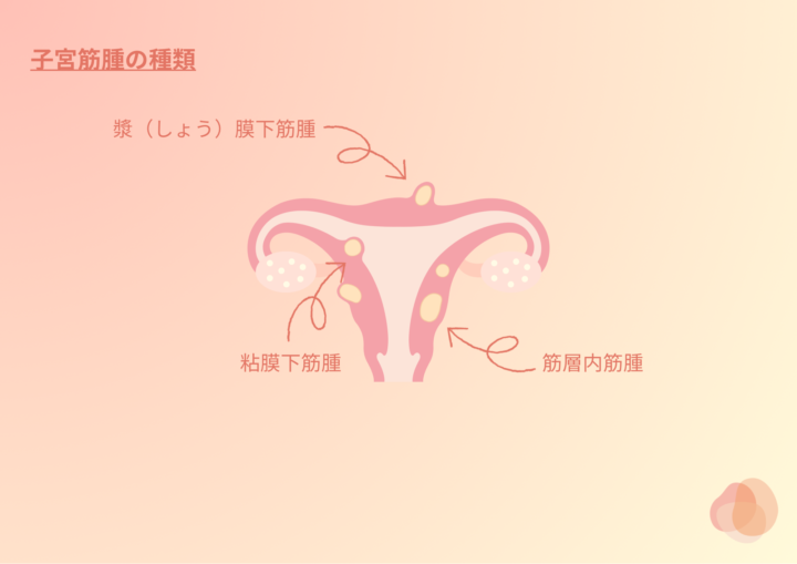 子宮筋腫についての画像