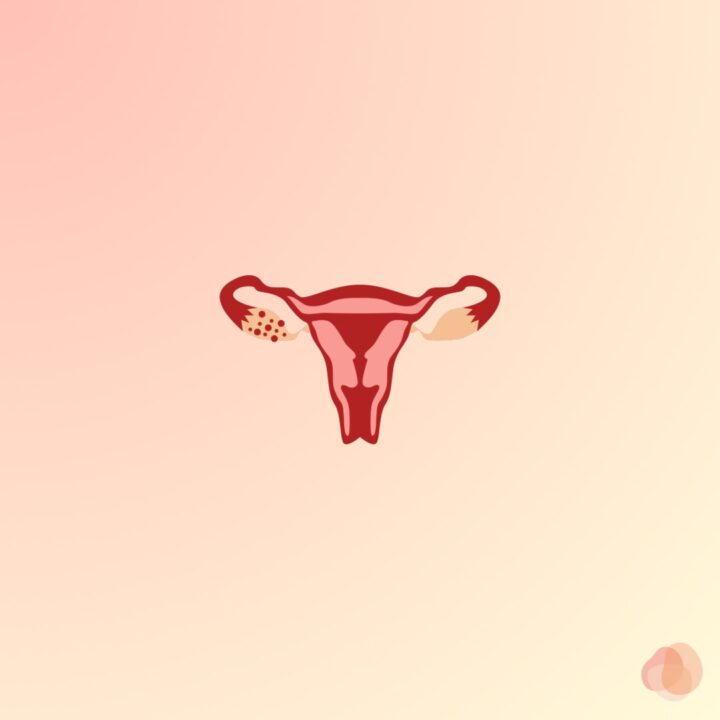 多のう胞性卵巣症候群　PCOSの画像
