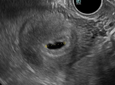 妊娠4週後半～５週頃