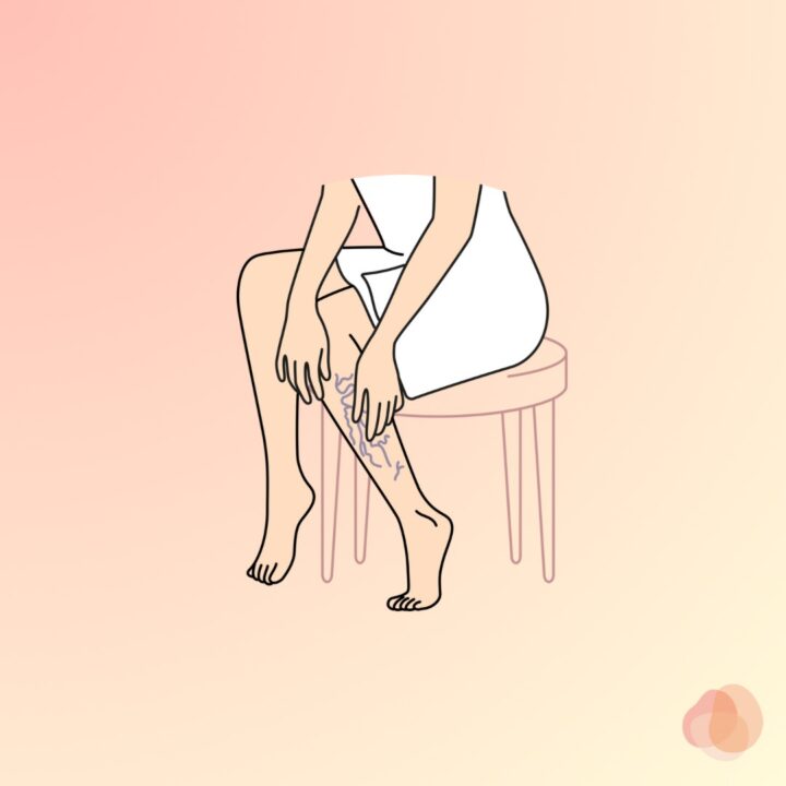 妊娠中静脈瘤の原因と対処法の画像